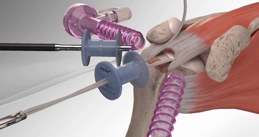 Rotator cuff repair in Faridabad